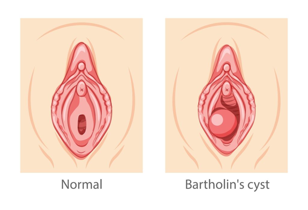 cisto de bartholin